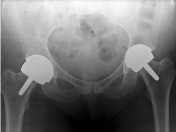 x-ray of hips